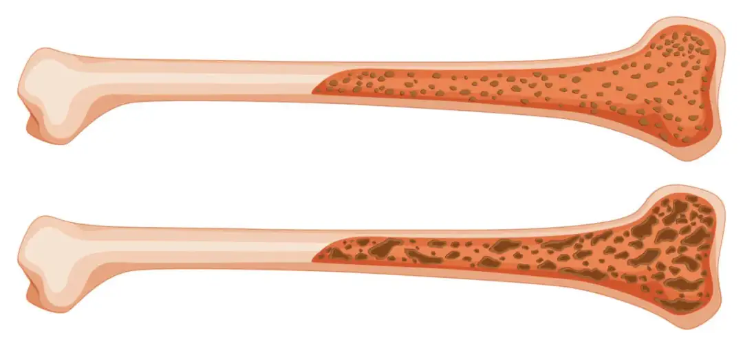 Jakie leki na osteoporozę bez recepty mogą naprawdę pomóc?