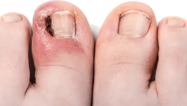 Wrastający paznokieć: Jak leczyć w domu i kiedy do podologa?