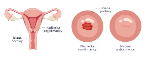 Obniżenie szyjki macicy objawy – jak rozpoznać niepokojące symptomy