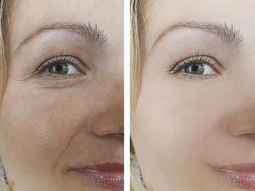 Jak długo utrzymuje się efekt po mikrodermabrazji? Odkryj prawdę!