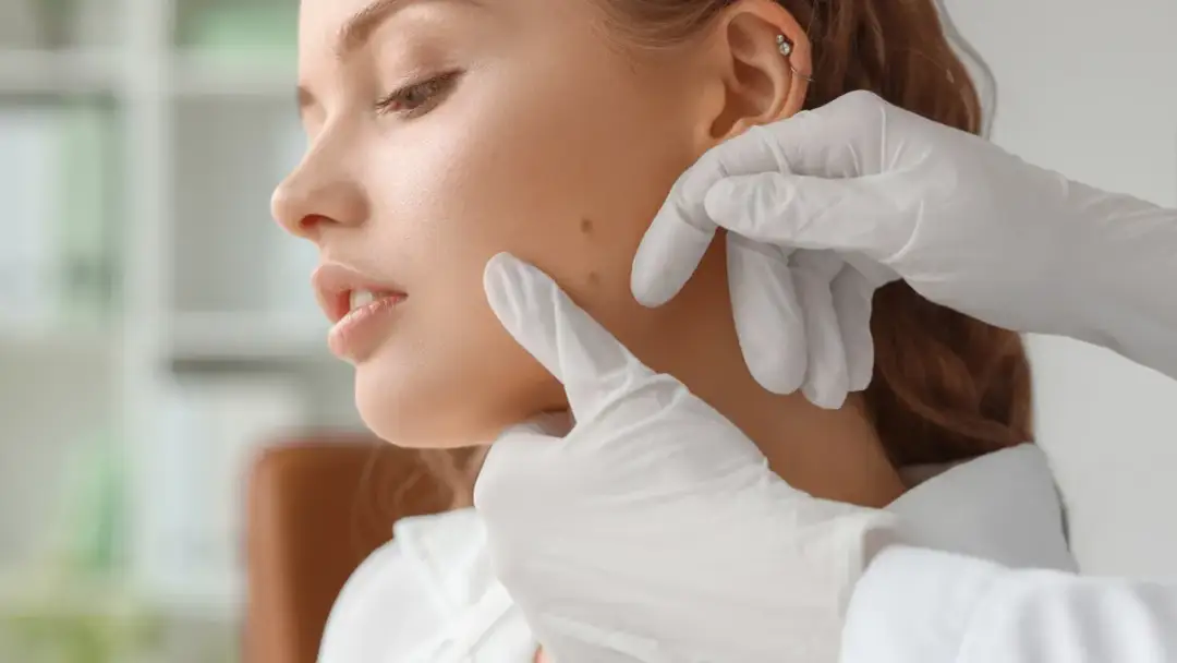 Jak skutecznie usunąć pryszcz na pieprzyku i uniknąć problemów zdrowotnych