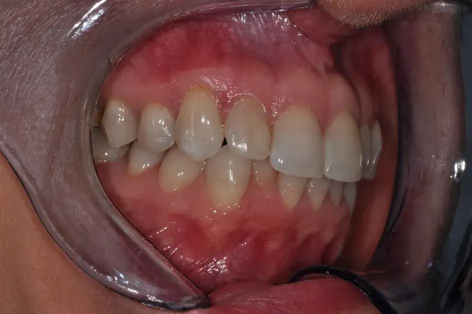 Nadwrażliwość zębów objawy: poznaj ból, który może cię zaskoczyć