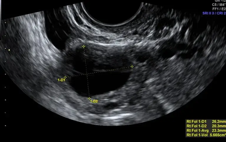 USG po owulacji co widać: kluczowe zmiany w jajnikach i macicy