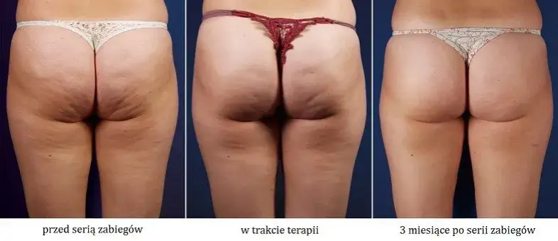 Jakie zioła na cellulit skutecznie redukują widoczność pomarańczowej skórki