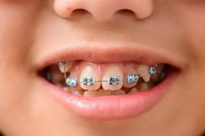 Ile kosztuje aparat na zęby dla dzieci? Ceny i ważne informacje