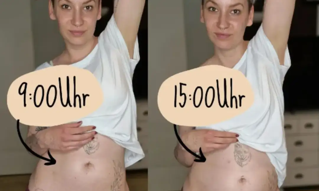 Endometrioza brzuch jak balon – przyczyny wzdęć i skuteczne metody łagodzenia