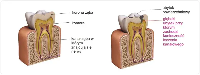 Ząb dwójka ile ma kanałów? Poznaj zaskakujące fakty o ich budowie