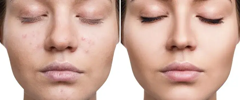 Jak zmniejszyć zaczerwienienie pryszcza - skuteczne metody na ulgę