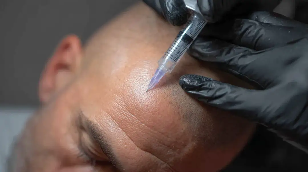 Mikropigmentacja skóry głowy: Kompleksowy przewodnik