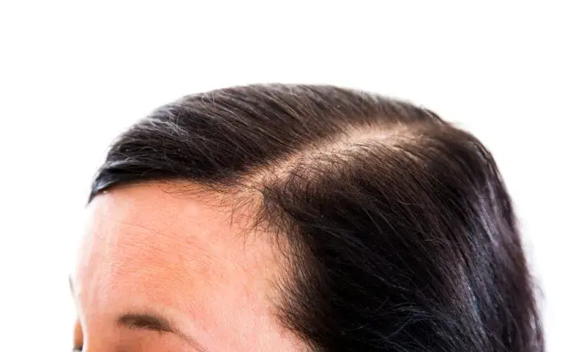 Przetłuszczające się i wypadające włosy: przyczyny i rozwiązania