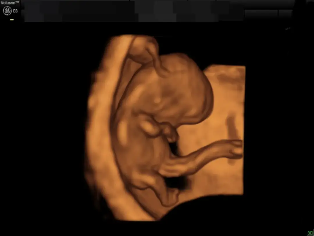 Pępowina dwunaczyniowa a poród: Naturalny czy cesarskie?