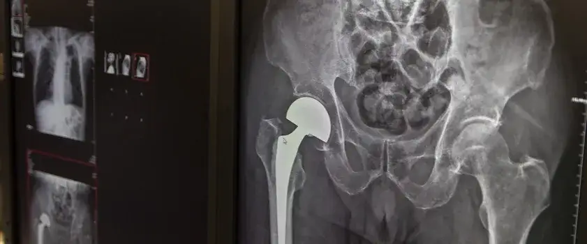 Obluzowanie endoprotezy stawu biodrowego – objawy, które mogą niepokoić