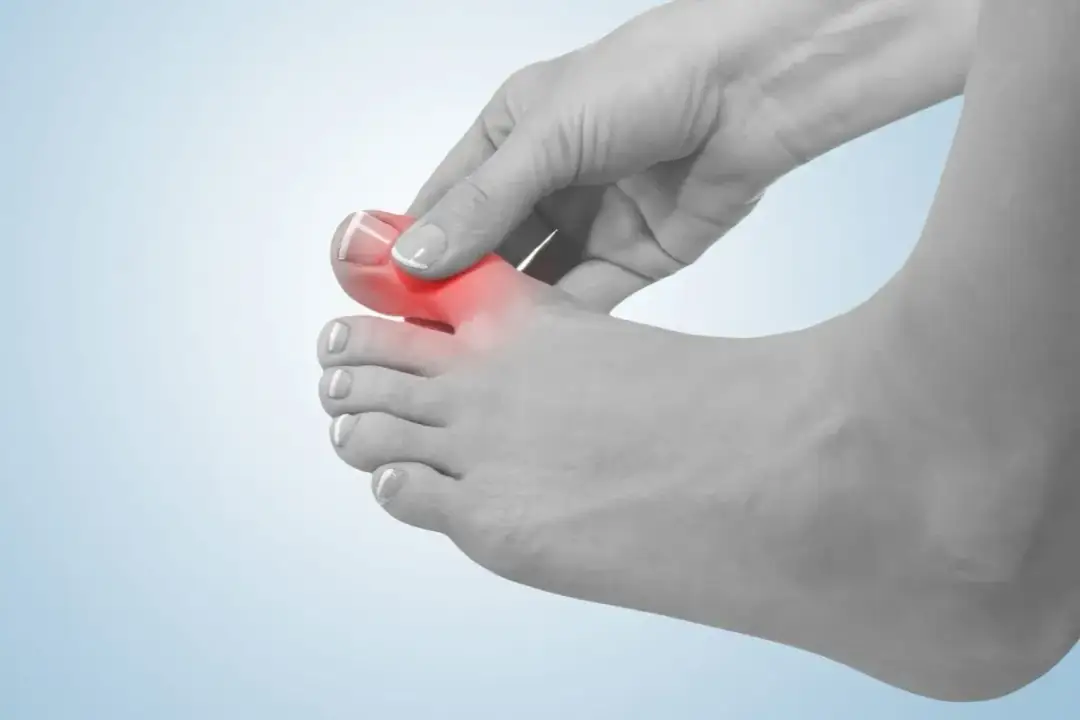 Jakie badania na dna moczanową pomogą uniknąć bólu stawów?