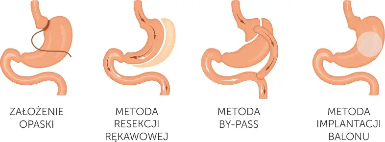 Operacja zmniejszenia żołądka na NFZ: lista ośrodków i wymogi 2025