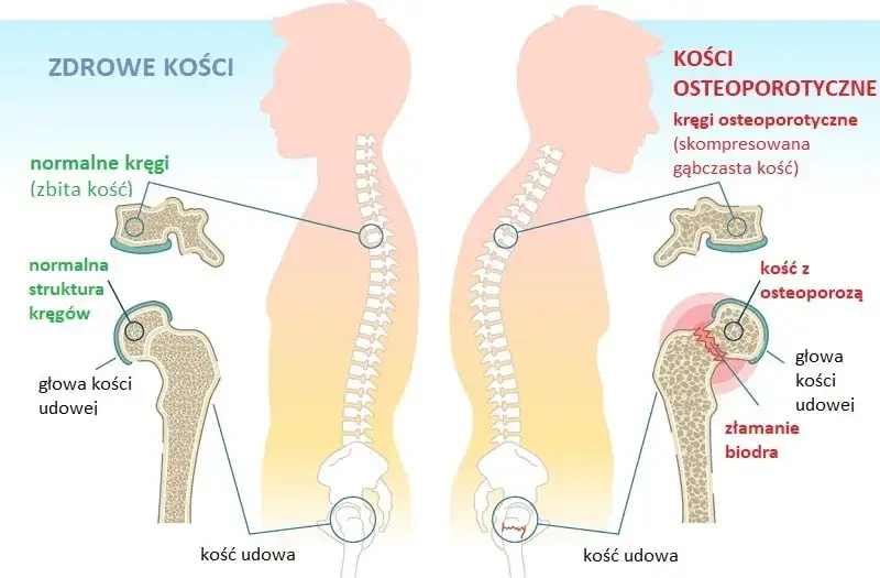 Objawy osteoporozy: jak je rozpoznać i kiedy udać się do lekarza