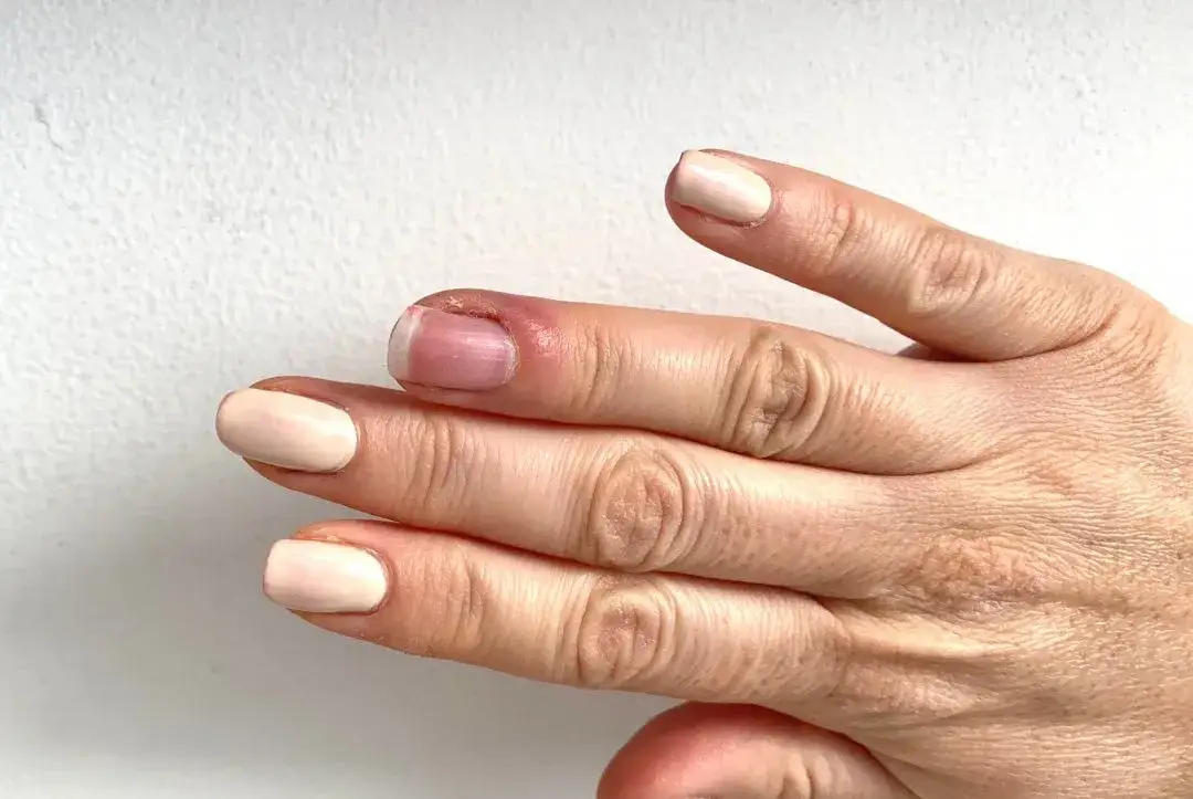 Czy paznokieć może nie odrosnąć? Przyczyny, leczenie i zapobieganie problemom