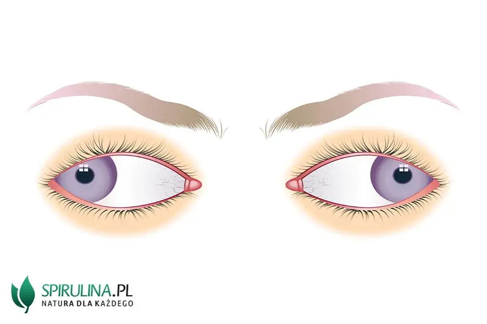 Co to jest zez rozbieżny? Objawy, przyczyny i skuteczne leczenie