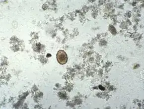 Tłuszcz w kale: Co oznacza i jak go rozpoznać? 6 ważnych wskazówek