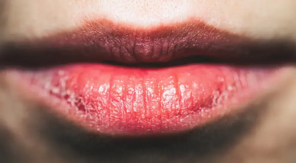 Przyczyny suchych ust: co je powoduje i jak temu zapobiec