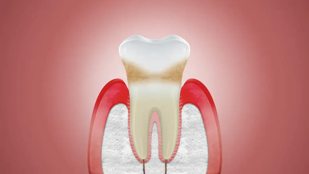 Jak odbudować dziąsła: Skuteczne metody na zdrowe dziąsła bez bólu