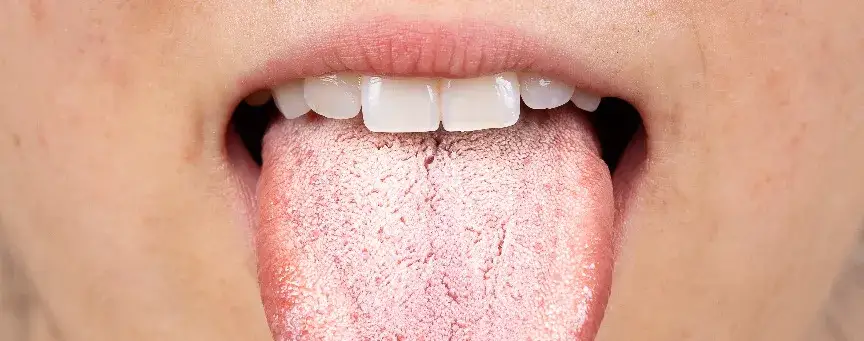 Jak leczyć grzybicę jamy ustnej skutecznie i szybko – poznaj metody