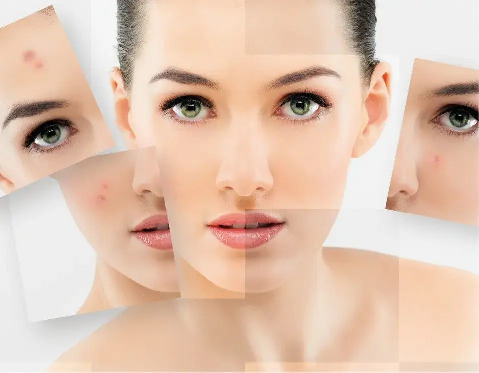 Jak skutecznie pielęgnować cerę trądzikową? Sprawdzone metody i kosmetyki