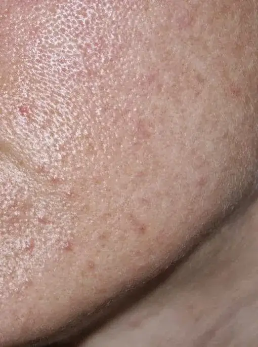 Jak wygląda zapchana cera? Objawy i skutki dla skóry