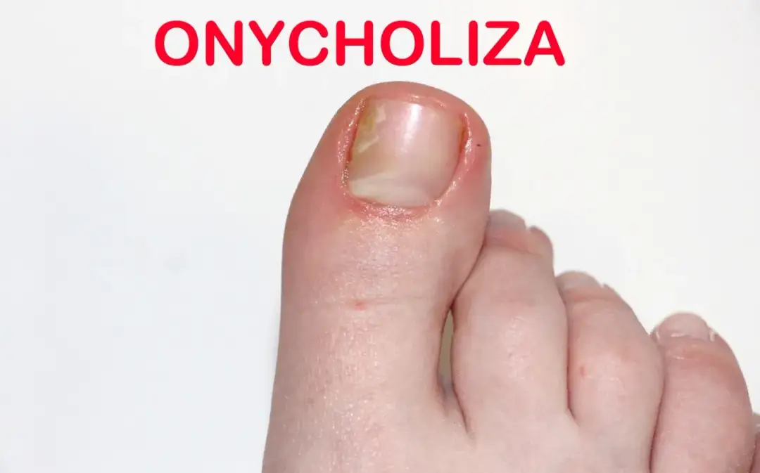 Onycholiza po hybrydzie: skuteczne metody leczenia i zapobiegania