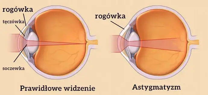 Czy astygmatyzm może się zmniejszyć? Poznaj prawdę o leczeniu i wieku