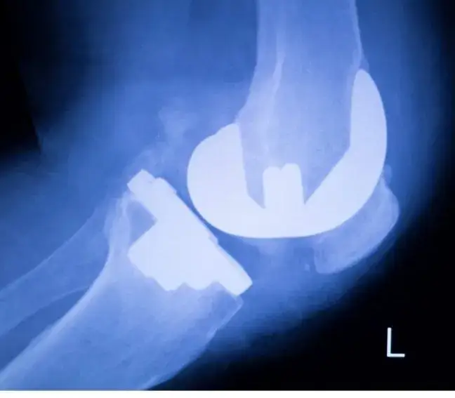 Kwas hialuronowy w kolano czy boli? Odkryj prawdę o bólu i skutkach