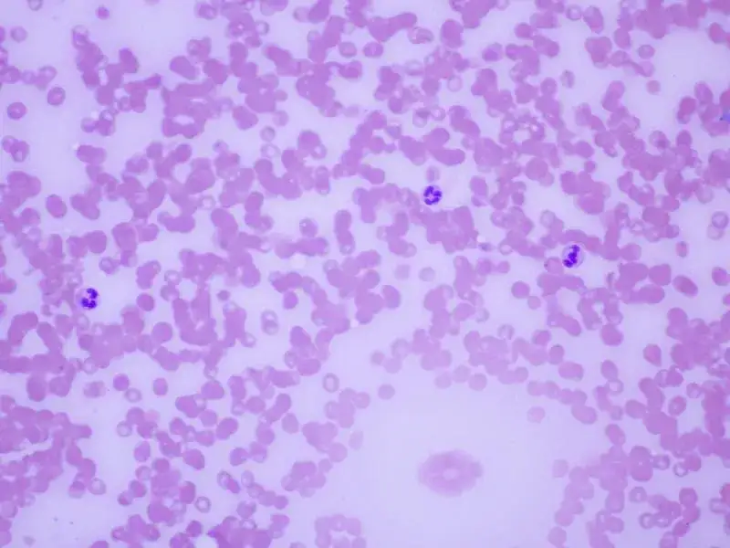 Podwyższony poziom granulocytów w ciąży - co powinno cię zaniepokoić?