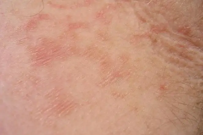 Gruźlica skóry - jak rozpoznać? Zdjęcia i objawy!