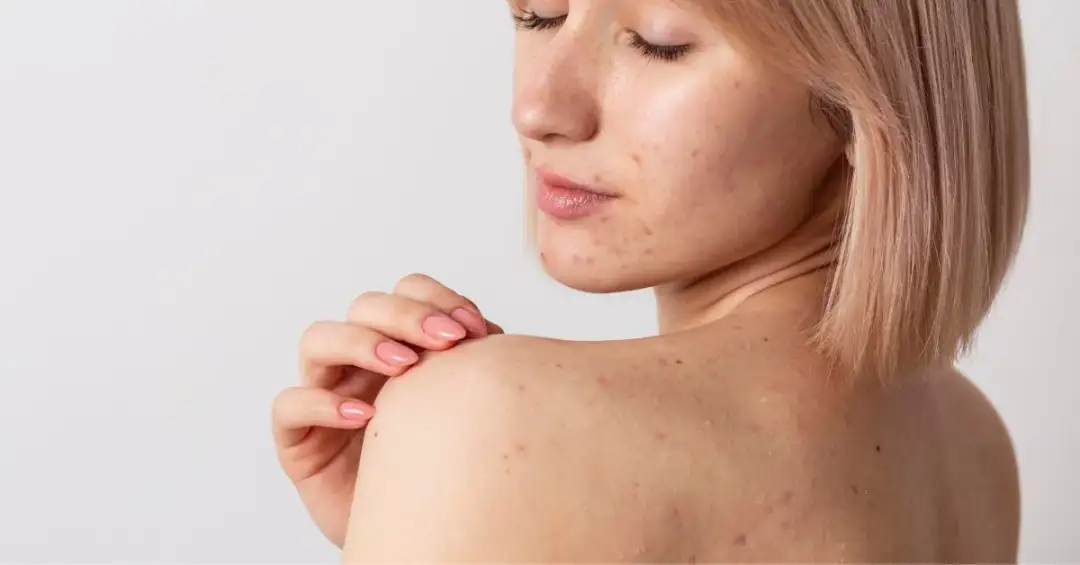 Jak pozbyć się śladów po pryszczach – skuteczne metody i porady