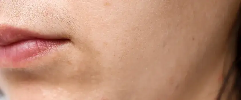 Podwyższony poziom testosteronu u kobiet: poznaj przyczyny i leczenie