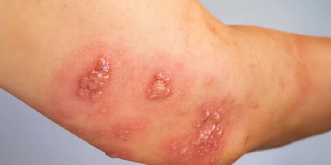 Wysypka od roztoczy: strategie radzenia sobie z problemem.