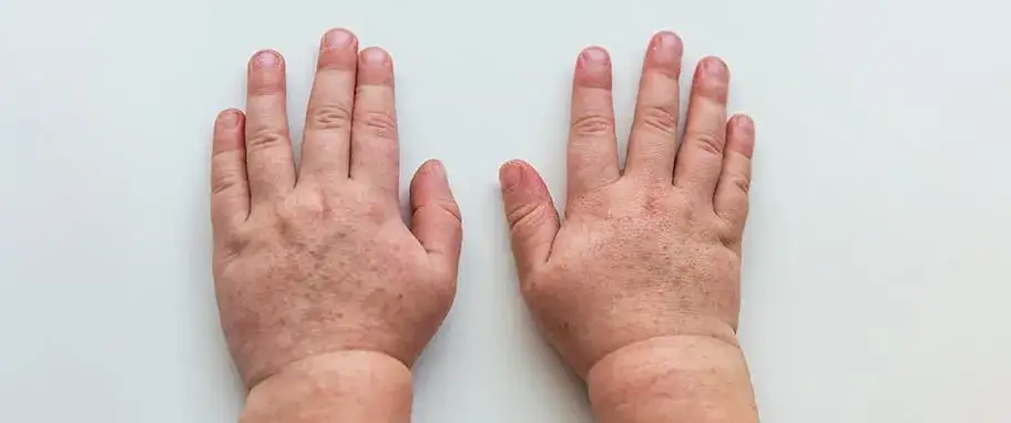 Szkarlatyna zakaźna - co musisz wiedzieć o izolacji i ochronie dziecka