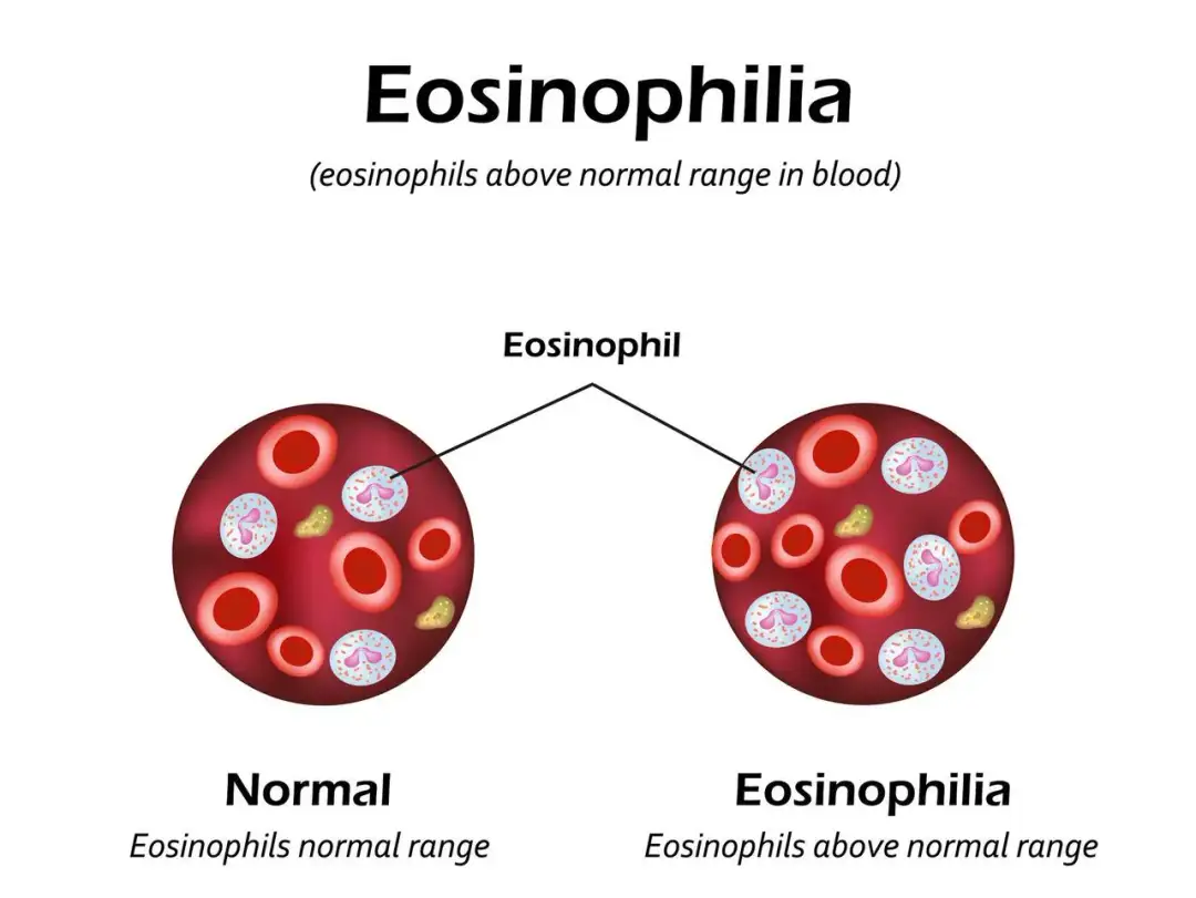 Podwyższony poziom eozynofili u dziecka: co powinien wiedzieć rodzic
