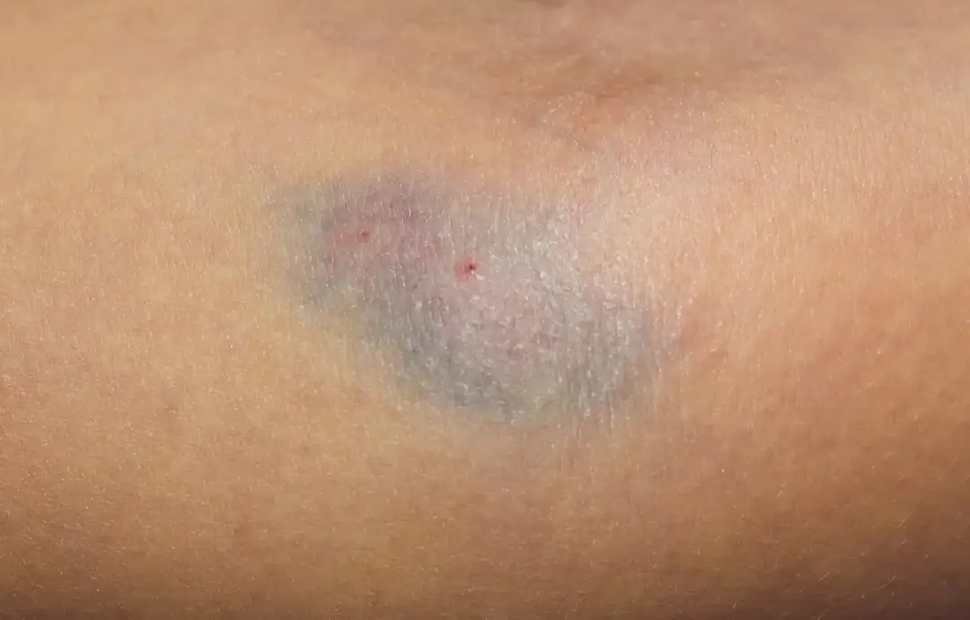 Skutki uboczne po wenflonie – poznaj poważne komplikacje i objawy