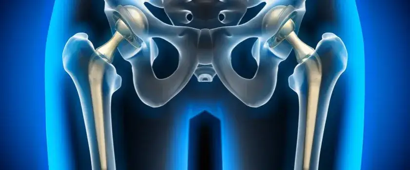 Ból stawu biodrowego objawy: Jak rozpoznać i złagodzić dolegliwości
