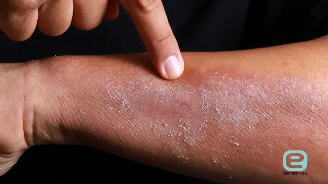 Alergia na nikiel w ustach? Rozpoznaj objawy i znajdź ulgę!