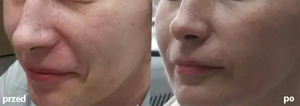 Laser frakcyjny kiedy makijaż - uniknij podrażnień i błędów