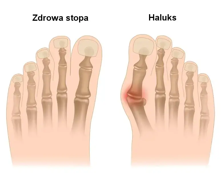 Ból haluksa: dlaczego stopa cierpi i jak znaleźć ulgę?