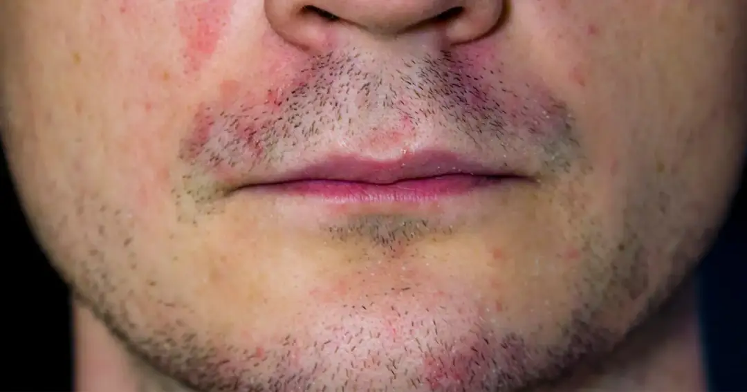 Trockene, schuppige Gesichtshaut? Ursachen, Soforthilfe & Pflegetipps