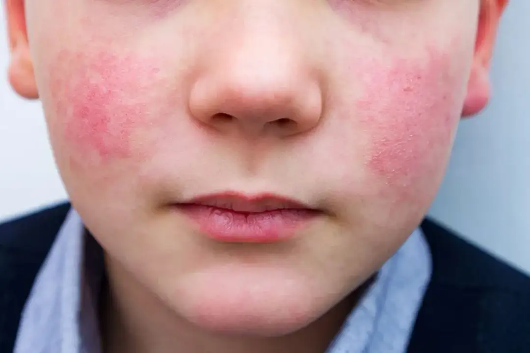 Rumień zakaźny u dziecka: okres zaraźliwości i bezpieczny powrót do szkoły