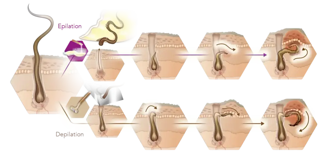 Eingewachsene Haare Intimbereich: Ursachen, Behandlung & Vorbeugung