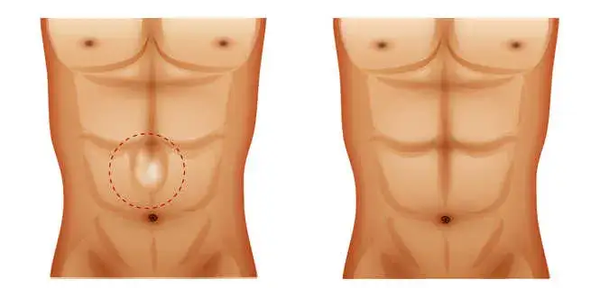 Jakie ćwiczenia przy przepuklinie pępkowej mogą pomóc uniknąć bólu?