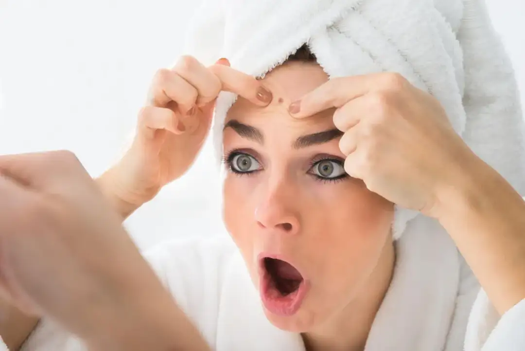 Pryszczy - jak sobie poradzić z nim domowymi sposobami?