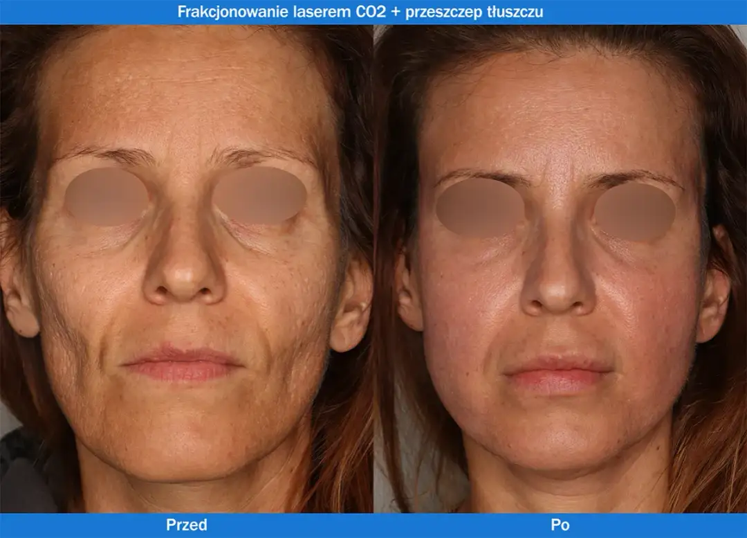 Jak często stosować laser frakcyjny, aby uniknąć rozczarowania?