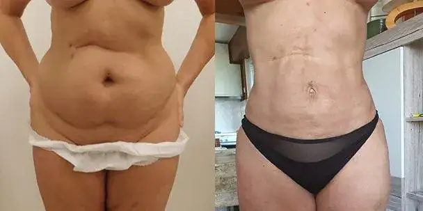 Liposukcja ultradźwiękowa ile zabiegów potrzebujesz, by schudnąć?