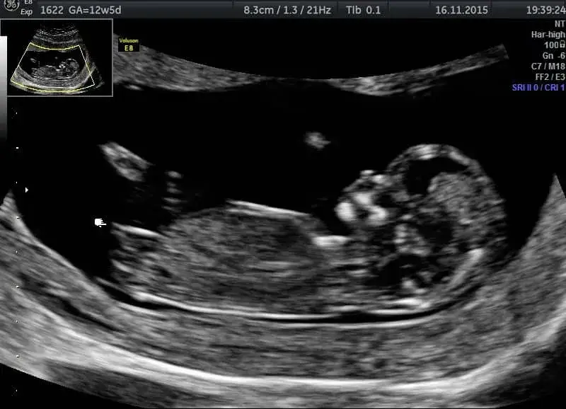 Jak wyglądają badania prenatalne w 13 tygodniu ciąży i co warto wiedzieć